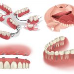 Cartoon images of partial dentures, full dentures, implant-supported dentures, and single dental implants to replace missing teeth