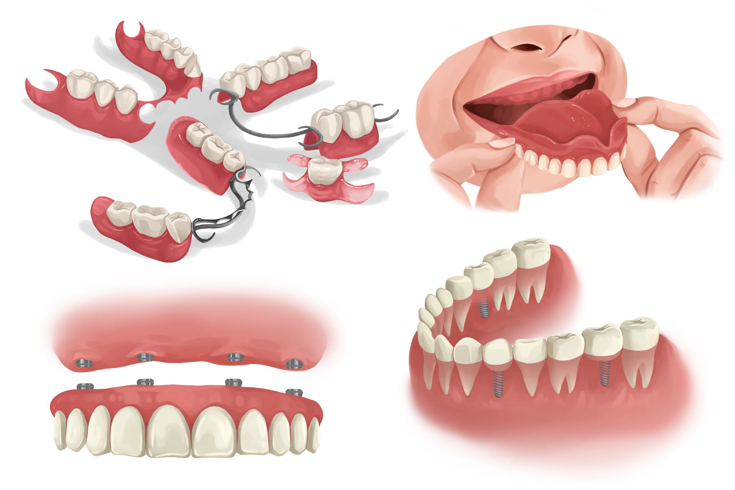 Cartoon images of partial dentures, full dentures, implant-supported dentures, and single dental implants to replace missing teeth