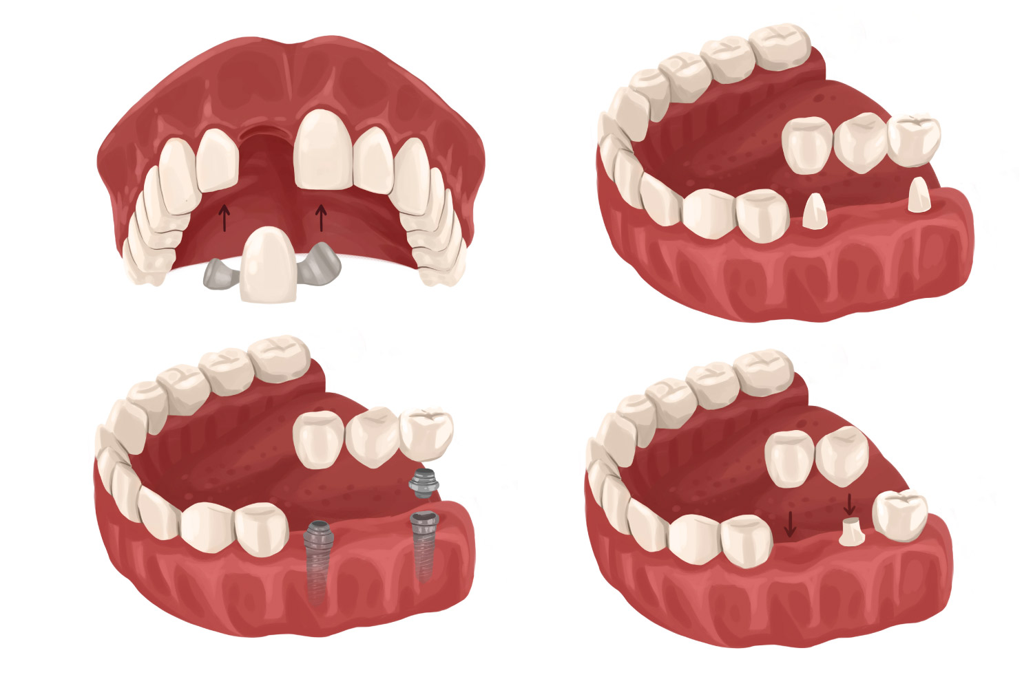 Cartoon configurations of dental bridges to replace a missing tooth in Denver, CO