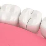 A cracked tooth that needs to be repaired at the dentist in Denver, CO