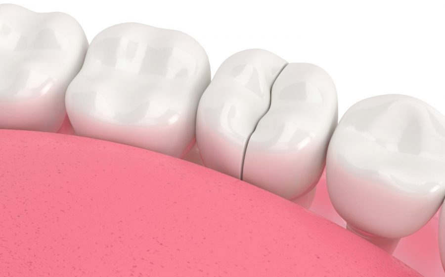 Can a Broken Tooth Be Fixed? Dental Blog Vero Dental