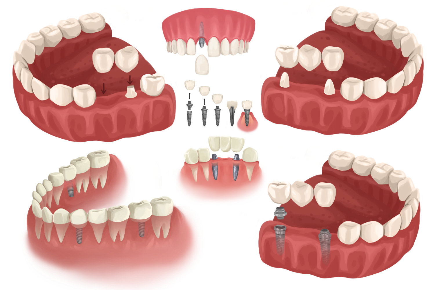 Illustration of different configurations of dental implants and dental bridges