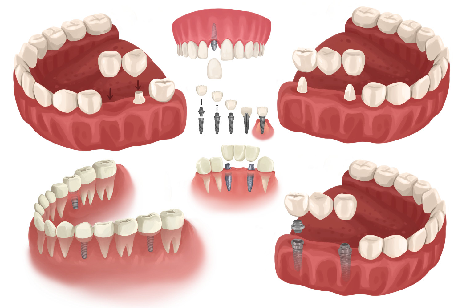 implant bridges Denver