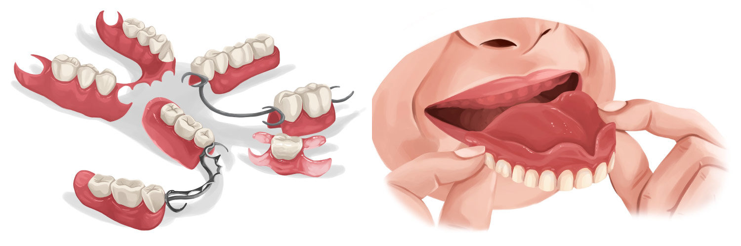 Illustration of partial dentures and a woman putting traditional full dentures into her mouth