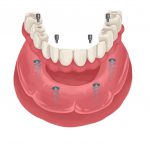 Illustration of implant-supported dentures on a lower arch to replace missing teeth
