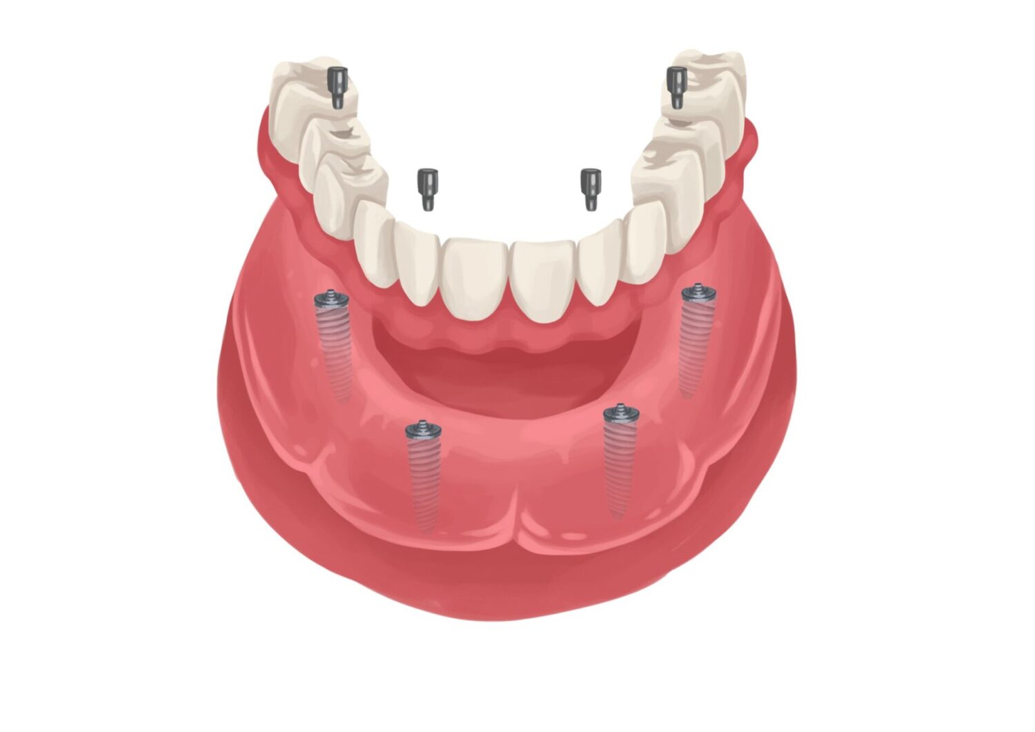 Illustration of implant-supported dentures on a lower arch to replace missing teeth