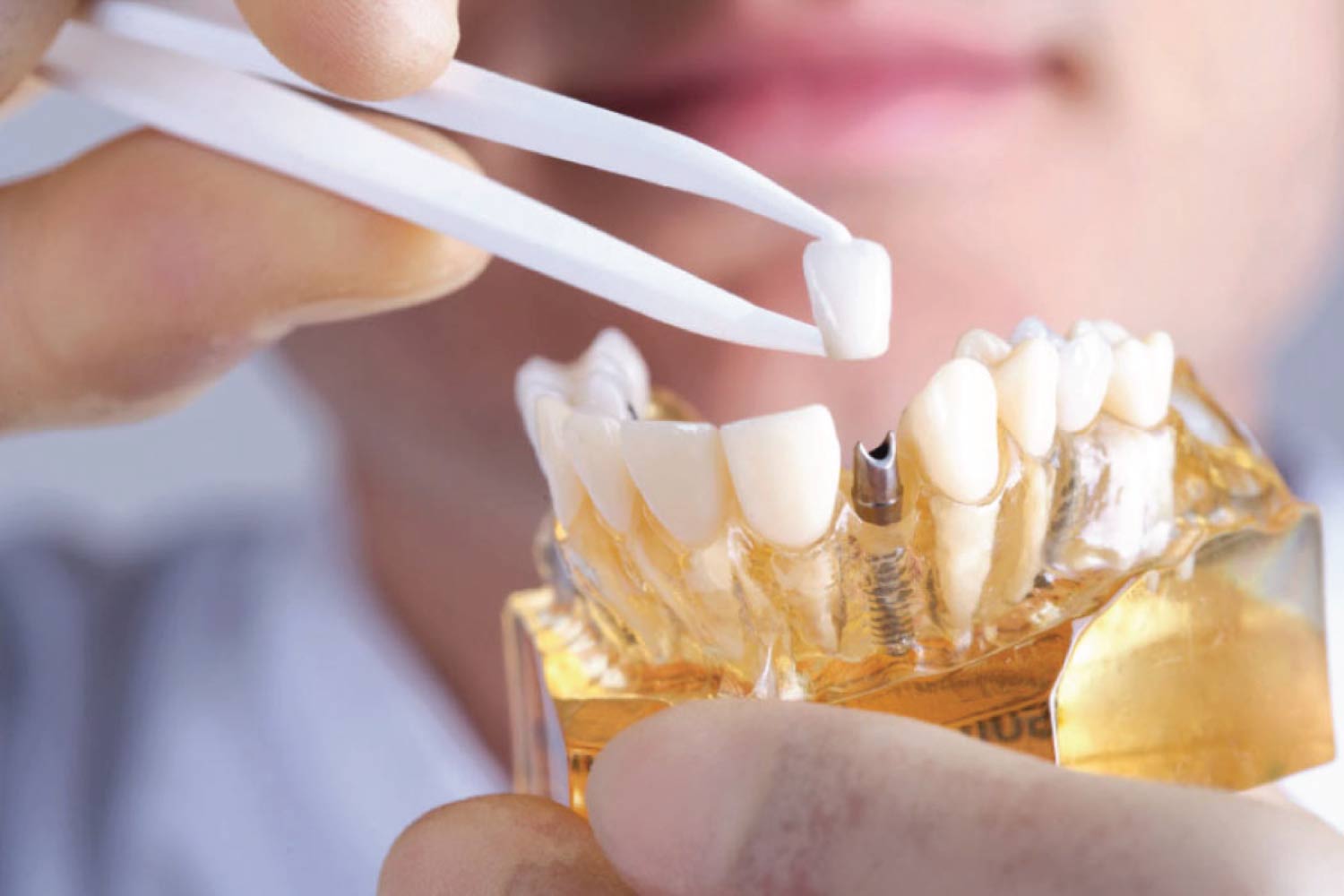 dental implant model being manipulated by a dentist