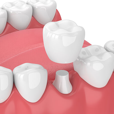 illustration of a dental crown