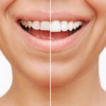 dental veneers in Denver, CO to correct imperfections