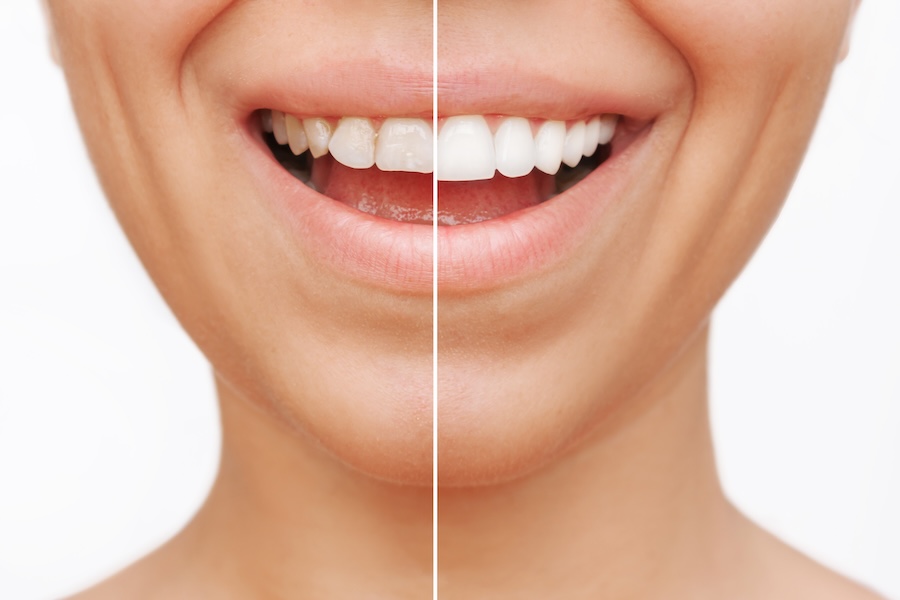 dental veneers in Denver, CO to correct imperfections