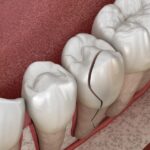 cracked tooth, types of tooth fractures