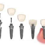 parts of a dental implant, failing dental implant, loose dental implant, wiggly dental implant