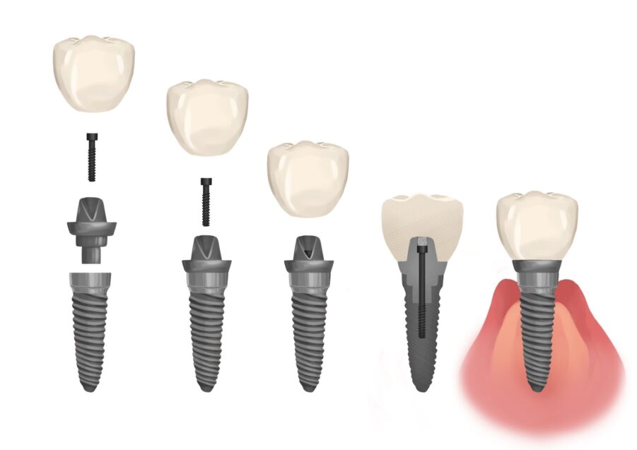 parts of a dental implant, failing dental implant, loose dental implant, wiggly dental implant