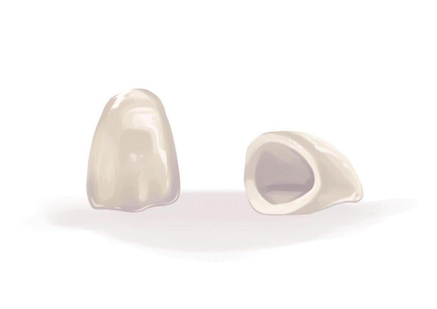 ceramic dental crown, loose dental crown