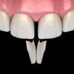 dental bonding on front teeth