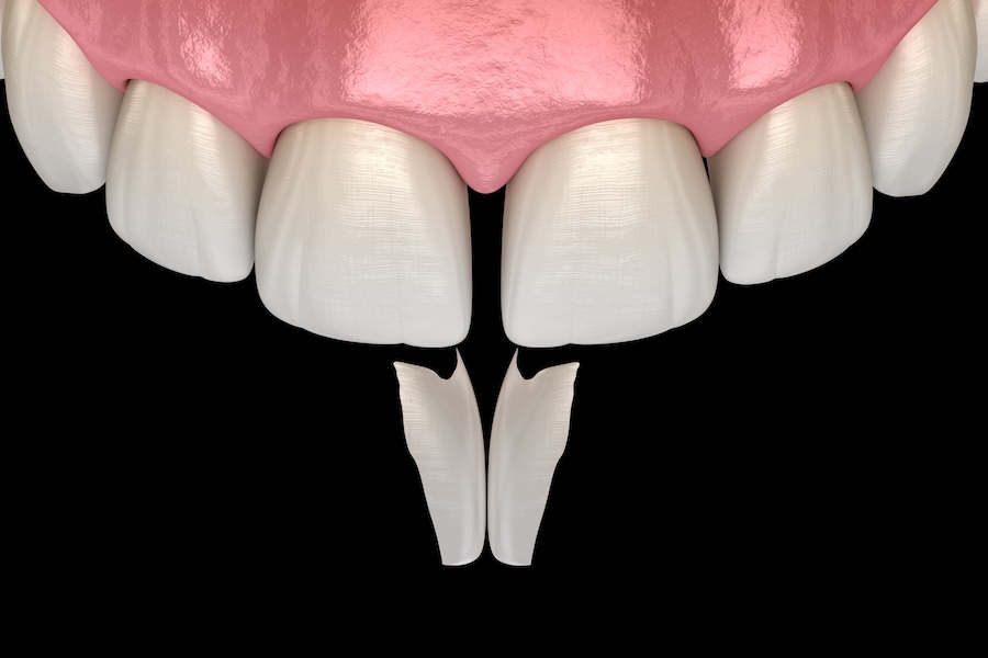 dental bonding on front teeth